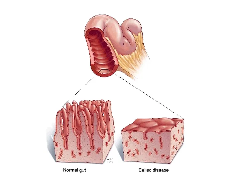 celiachia